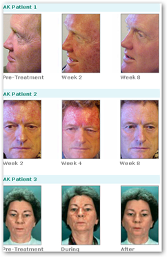 Skin cancer drug smoothes wrinkles - Study - Medical Quack